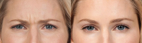 Injectables Before & Afters
