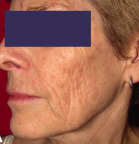 laser skin resurfacing treatment