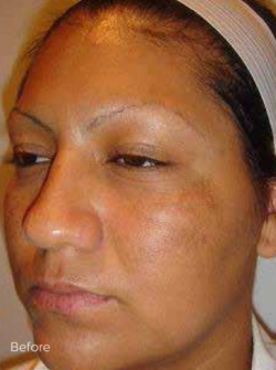 Cosmelan®MD Depigmentation Treatment