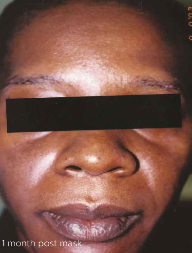 Cosmelan®MD Depigmentation Treatment