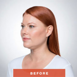 Kybella Fat Removal (For Double Chin)