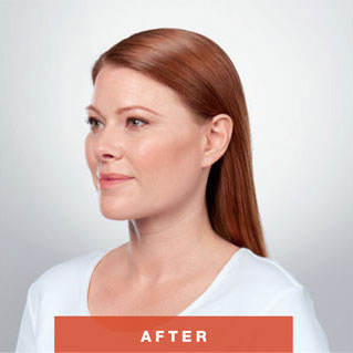 Kybella Fat Removal (For Double Chin)