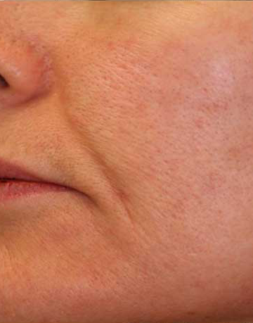 laser genesis before and after results