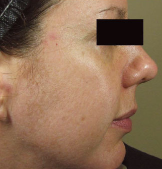 micro-needling before and after results