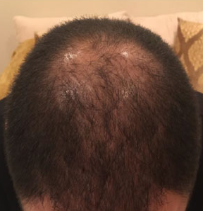 prp hair restoration before and after results