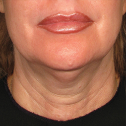 Ultherapy Non Invasive Face lift