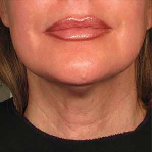 ultherapy non invasive face lift before and after results