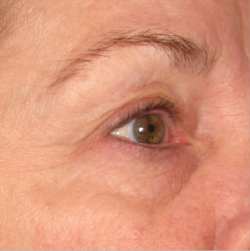 Ultherapy Non Invasive Face lift