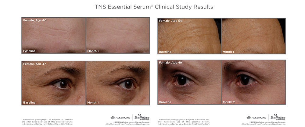 TNS essential serum clinical study results