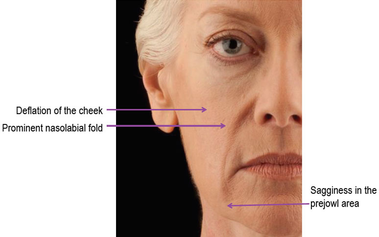 signs of age-related midface volume loss