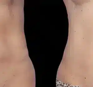 Coolsculpting® Elite Body Contouring before and after photo by La Bella Laser & Slimming Inc. in Arcadia, CA