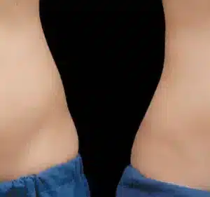 Coolsculpting® Elite Body Contouring before and after photo by La Bella Laser & Slimming Inc. in Arcadia, CA