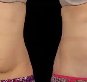 Coolsculpting® Elite Body Contouring before and after photo by La Bella Laser & Slimming Inc. in Arcadia, CA