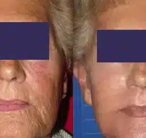 CO2 Skin Resurfacing before and after photo by La Bella Laser & Slimming Inc. in Arcadia, CA