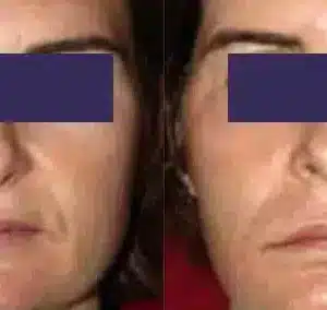 CO2 Skin Resurfacing before and after photo by La Bella Laser & Slimming Inc. in Arcadia, CA