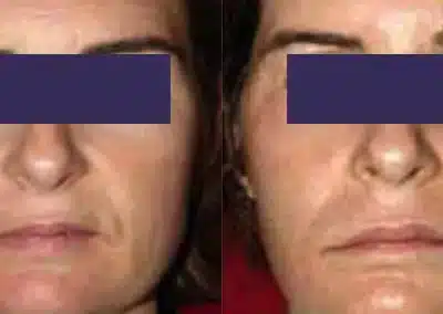 CO2 Skin Resurfacing before and after photo by La Bella Laser & Slimming Inc. in Arcadia, CA