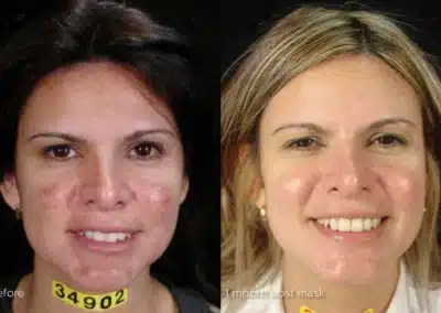 Cosmelan®MD Depigmentation Treatment before and after photo by La Bella Laser & Slimming Inc. in Arcadia, CA