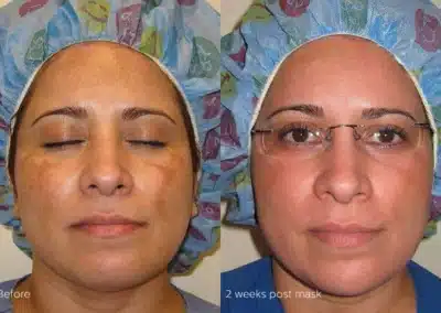 Cosmelan®MD Depigmentation Treatment before and after photo by La Bella Laser & Slimming Inc. in Arcadia, CA