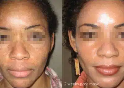 Cosmelan®MD Depigmentation Treatment before and after photo by La Bella Laser & Slimming Inc. in Arcadia, CA
