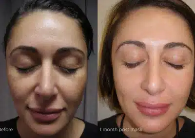 Cosmelan®MD Depigmentation Treatment before and after photo by La Bella Laser & Slimming Inc. in Arcadia, CA