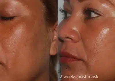 Cosmelan®MD Depigmentation Treatment before and after photo by La Bella Laser & Slimming Inc. in Arcadia, CA