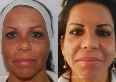 Cosmelan®MD Depigmentation Treatment before and after photo by La Bella Laser & Slimming Inc. in Arcadia, CA