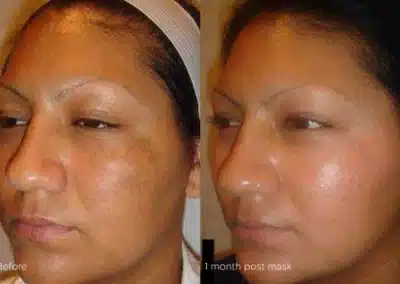 Cosmelan®MD Depigmentation Treatment before and after photo by La Bella Laser & Slimming Inc. in Arcadia, CA