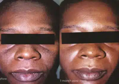Cosmelan®MD Depigmentation Treatment before and after photo by La Bella Laser & Slimming Inc. in Arcadia, CA