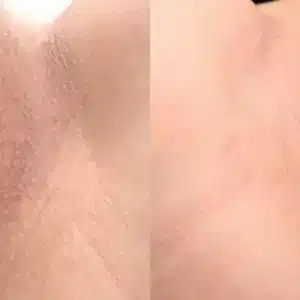 Before and after Dermamelan Intimate treatment results