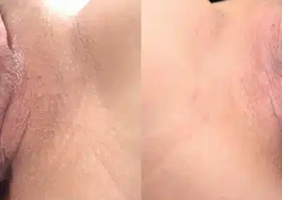 Before and after Dermamelan Intimate treatment results