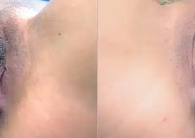 Dermamelan Intimate before and after photo by La Bella Laser & Slimming Inc. in Arcadia, CA