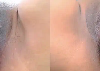 Dermamelan Intimate before and after photo by La Bella Laser & Slimming Inc. in Arcadia, CA
