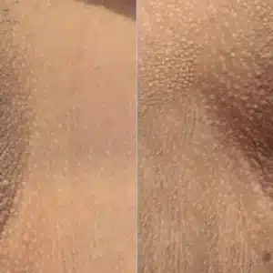 Dermamelan Intimate before and after photo by La Bella Laser & Slimming Inc. in Arcadia, CA