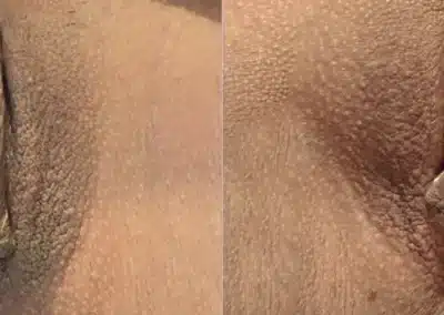 Dermamelan Intimate before and after photo by La Bella Laser & Slimming Inc. in Arcadia, CA