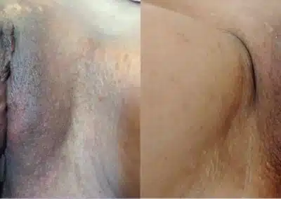 Dermamelan Intimate before and after photo by La Bella Laser & Slimming Inc. in Arcadia, CA