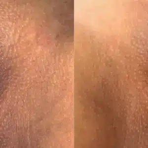 Dermamelan Intimate before and after photo by La Bella Laser & Slimming Inc. in Arcadia, CA