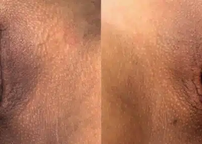 Dermamelan Intimate before and after photo by La Bella Laser & Slimming Inc. in Arcadia, CA