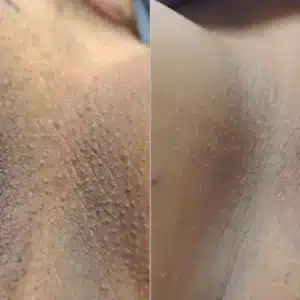 Dermamelan Intimate before and after photo by La Bella Laser & Slimming Inc. in Arcadia, CA