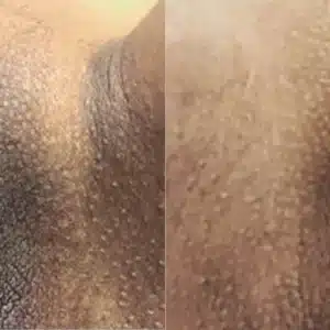 Dermamelan Intimate before and after photo by La Bella Laser & Slimming Inc. in Arcadia, CA