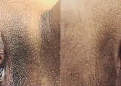 Dermamelan Intimate before and after photo by La Bella Laser & Slimming Inc. in Arcadia, CA