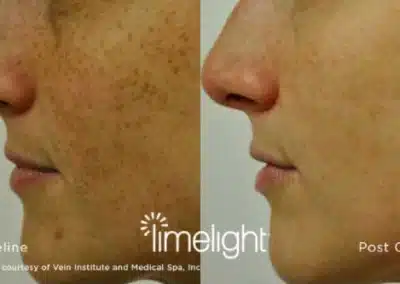 IPL Photo Facial before and after photo by La Bella Laser & Slimming Inc. in Arcadia, CA