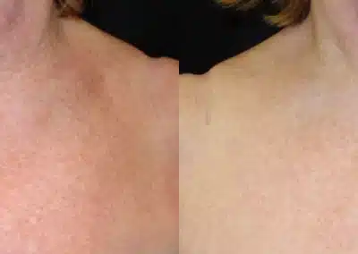 IPL Photo Facial before and after photo by La Bella Laser & Slimming Inc. in Arcadia, CA