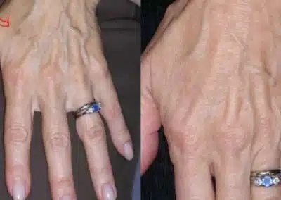 IPL Photo Facial before and after photo by La Bella Laser & Slimming Inc. in Arcadia, CA