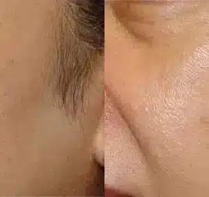 IPL Photo Facial before and after photo by La Bella Laser & Slimming Inc. in Arcadia, CA