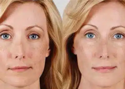 Juvéderm Ultra & Ultra Plus before and after photo by La Bella Laser & Slimming Inc. in Arcadia, CA