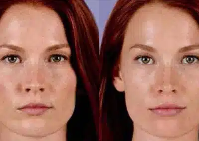 Juvéderm Ultra & Ultra Plus before and after photo by La Bella Laser & Slimming Inc. in Arcadia, CA