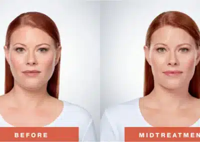 Kybella Fat Removal (For Double Chin) before and after photo by La Bella Laser & Slimming Inc. in Arcadia, CA