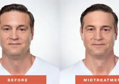 Kybella Fat Removal (For Double Chin) before and after photo by La Bella Laser & Slimming Inc. in Arcadia, CA