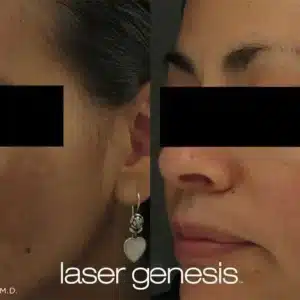Laser Genesis before and after photo by La Bella Laser & Slimming Inc. in Arcadia, CA