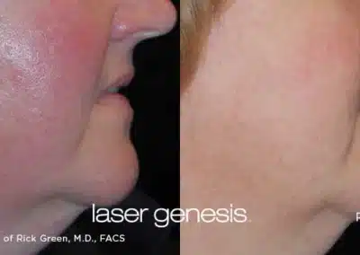 Laser Genesis before and after photo by La Bella Laser & Slimming Inc. in Arcadia, CA